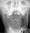 jefferson fracture